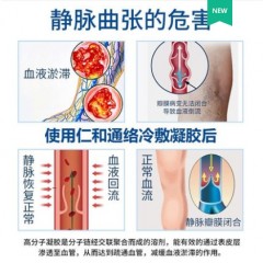 仁和静脉曲张型脉舒冷敷凝胶精索脉曲张药膏按摩缓解扩张专用