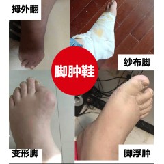 老年人脚肿糖尿病鞋病人拇指外翻